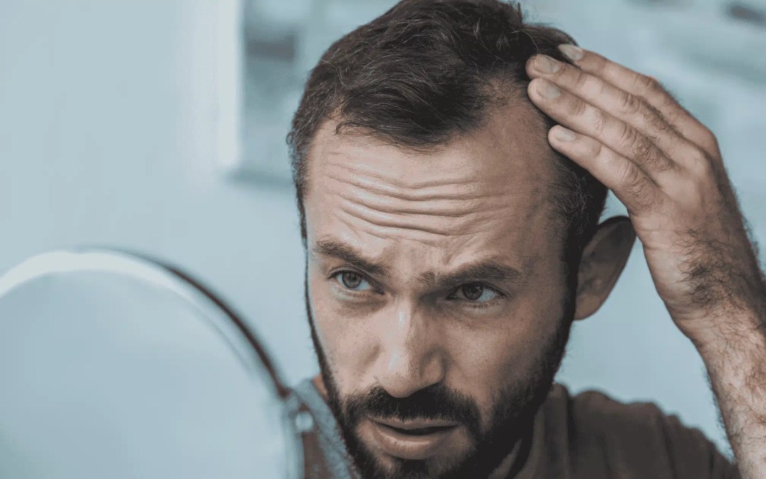 Alopecia Sufferers – 9 Crucial Things To Know